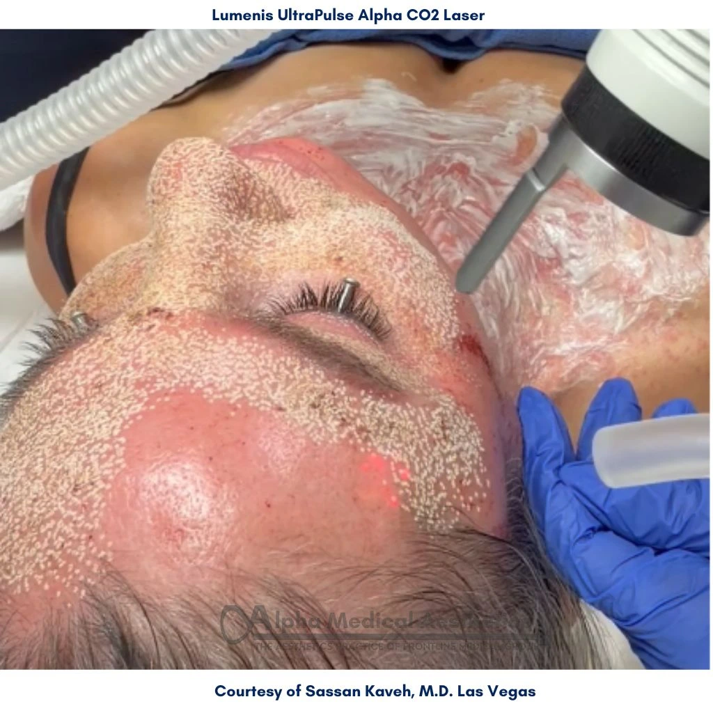 Alpha_Medical_Aesthetics_Lumenis_UltraPulse_Alpha_CO2_Laser_Device_By_Dr._Sassan_Kaveh_Las_Vegas
