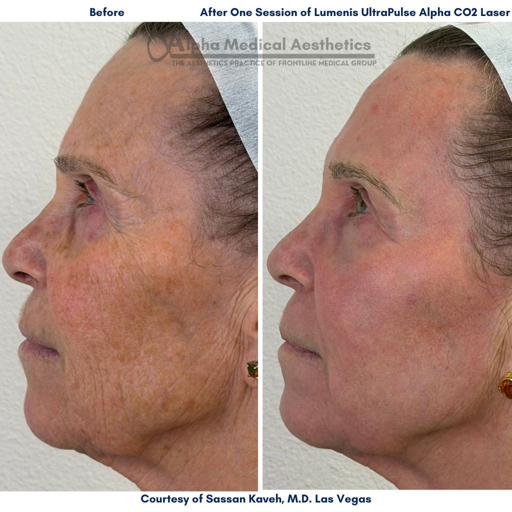 Alpha_Medical_Aesthetics_Ultra_Pulse_Alpha_CO2_Laser_Before_After_Dr._Sassan_Kaveh_Centennial