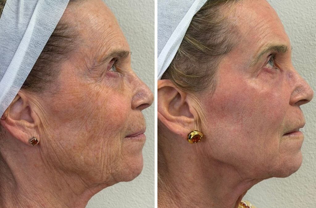 Botox vs CO2 laser Las Vegas