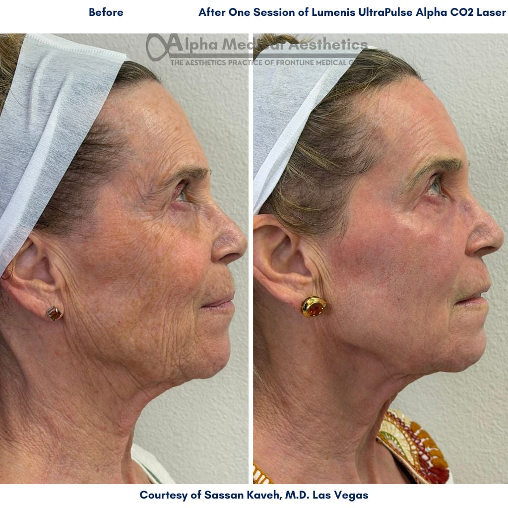 Botox vs CO2 laser in Las Vegas