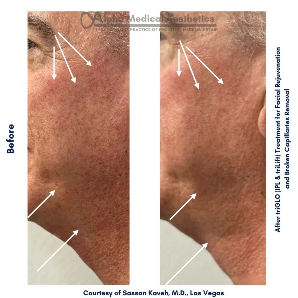 Alpha_Medical_Aesthetics_Lumenis_IPL_Stellar_M22_Broken_Capillaries_Removal_in_Las-Vegas_Dr._Sassan_Kaveh Alpha_Medical_Aesthetics_Lumenis_IPL_Stellar_M22_Broken_Capillaries_Removal_in_Las-Vegas_Dr._Sassan_Kaveh