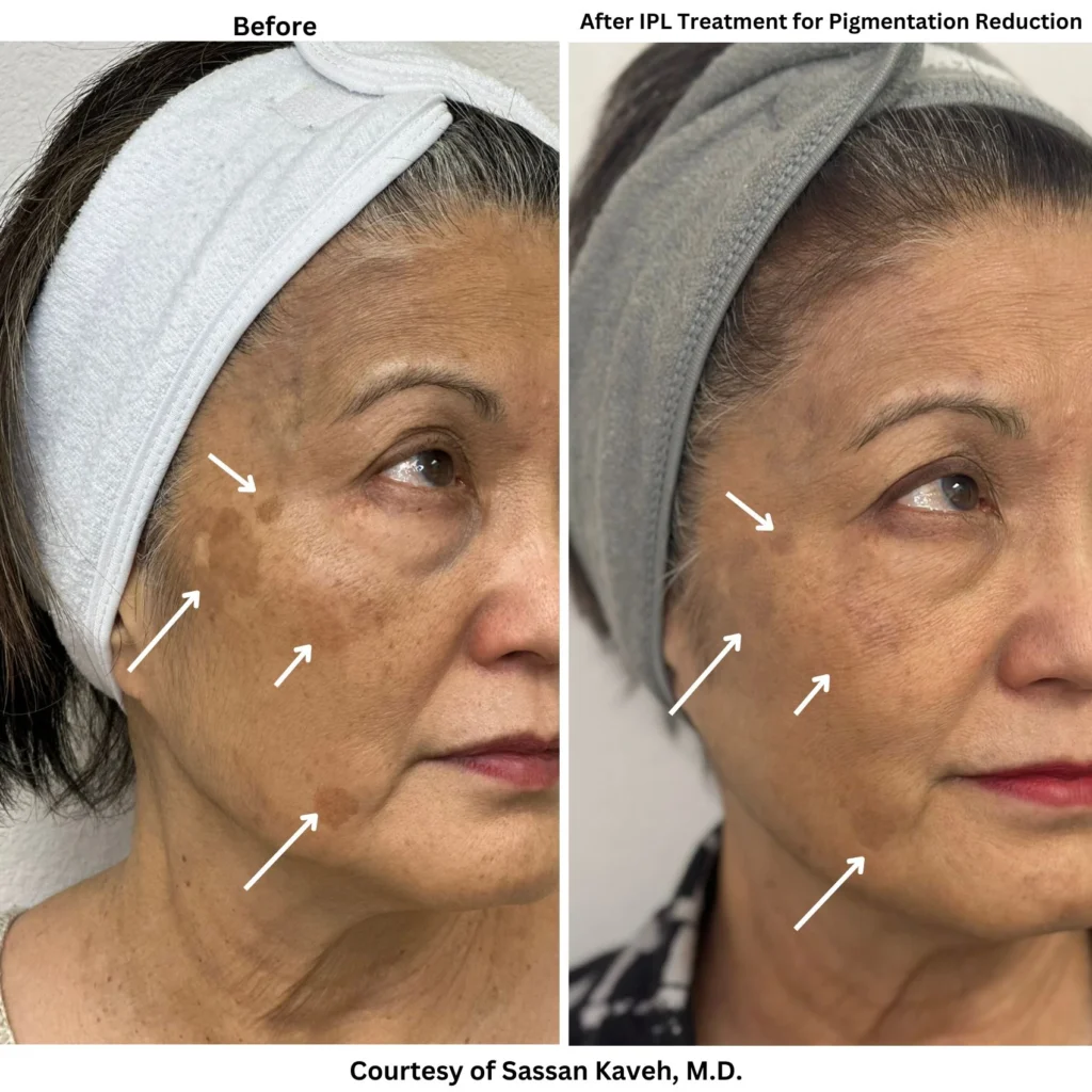 Alpha_Medical_Aesthetics_Lumenis_IPL_Stellar_M22_Hyper_Pigmentation_Treatment_in_Las Vegas_Dr._Sassan_Kaveh Alpha_Medical_Aesthetics_Lumenis_IPL_Stellar_M22_Hyper_Pigmentation_Treatment_in_Las Vegas_Dr._Sassan_Kaveh