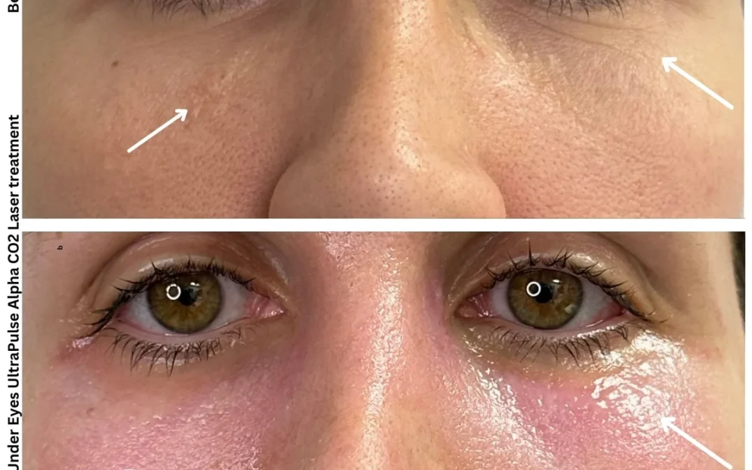 CO2 Laser Around Eyes in Las Vegas: Do You Need Blepharoplasty?