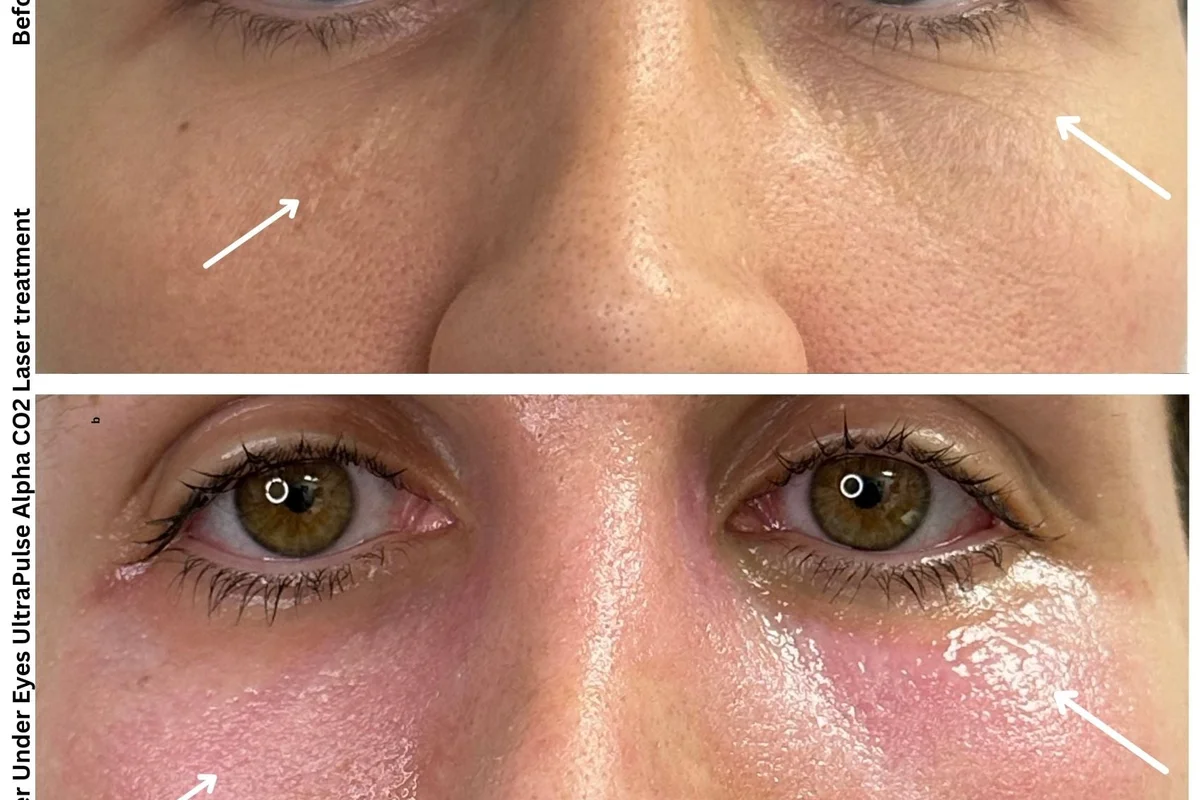 Alpha_Medical_Aesthetics_Lumenis_UltraPulse_Alpha_CO2_Laser_Around_Eyes_Featured_By_Dr._Sassan_Kaveh_Las_Vegas