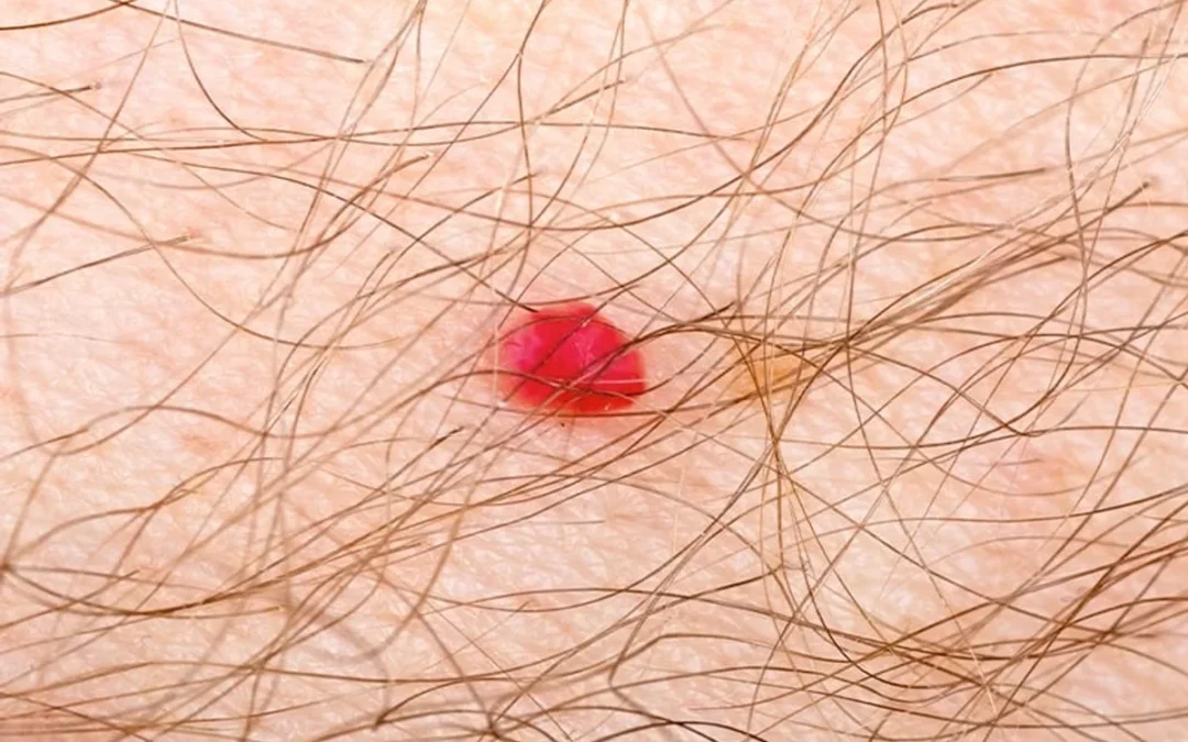 Superfrecator Treatment in Las Vegas: One-Session Removal of Skin Tags, Sun Spots, and Benign Skin Lesions