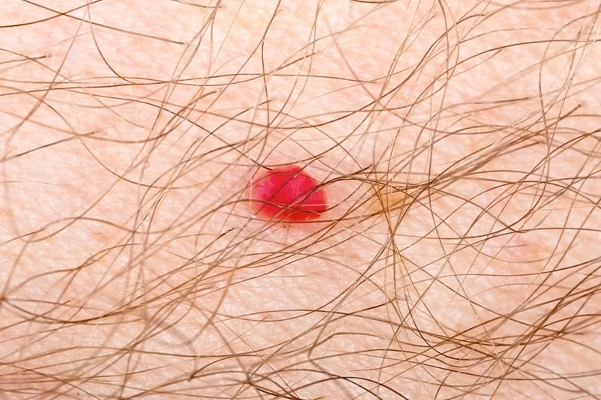 Superfrecator treatment in Las Vegas at Alpha Medical Aesthetics