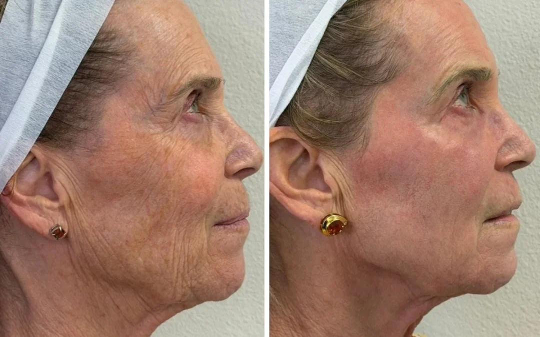 Botox vs CO2 laser Las Vegas
