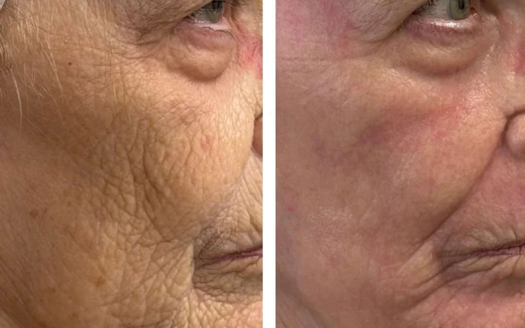 CO2 Laser Downtime