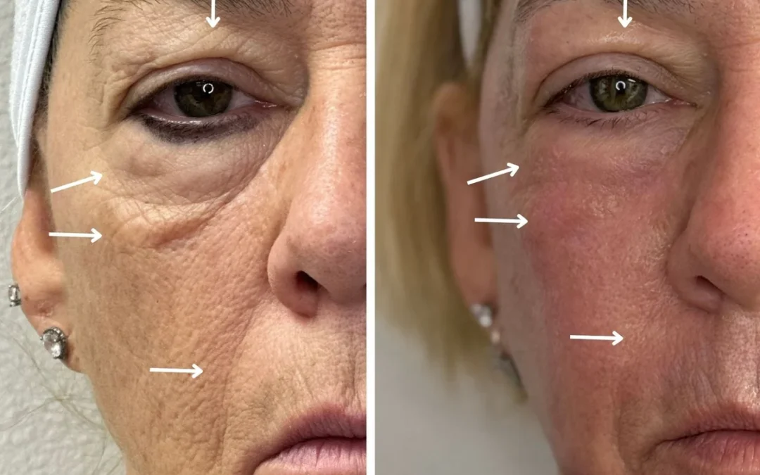 CO2 Laser Resurfacing Around Eyes: The Best Non-Surgical Fix for Fine Lines and Eye Bags