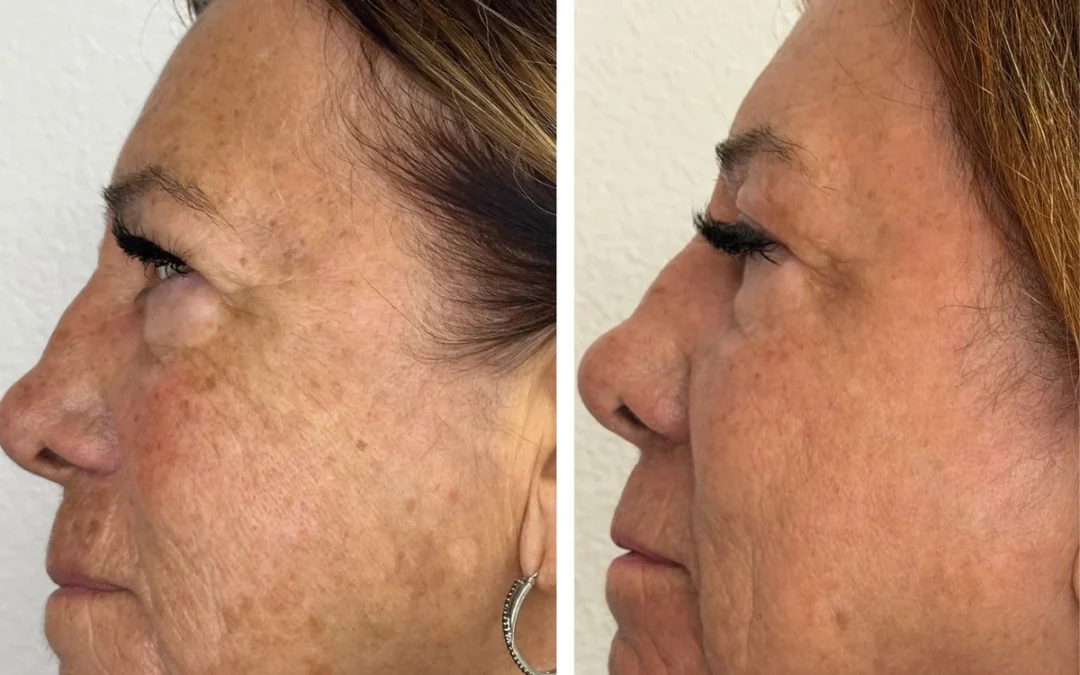 CO2 Laser Resurfacing Realistic Results, Downtime, and Cost Breakdown at Alpha Medical Aesthetics