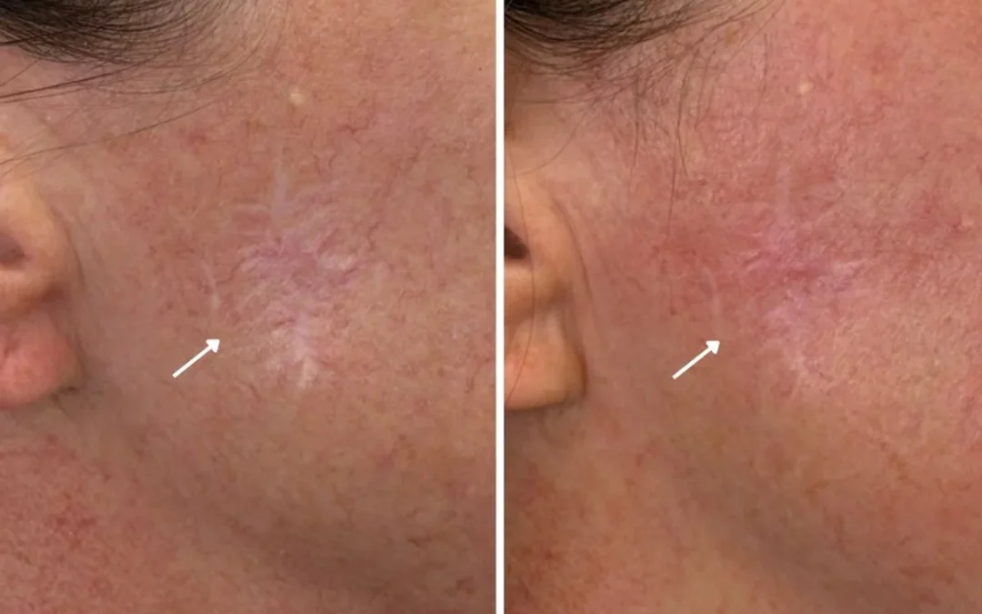 Facial Scar Removal in Las Vegas: What Actually Works for Acne Scars, Surgical Scars, and Texture