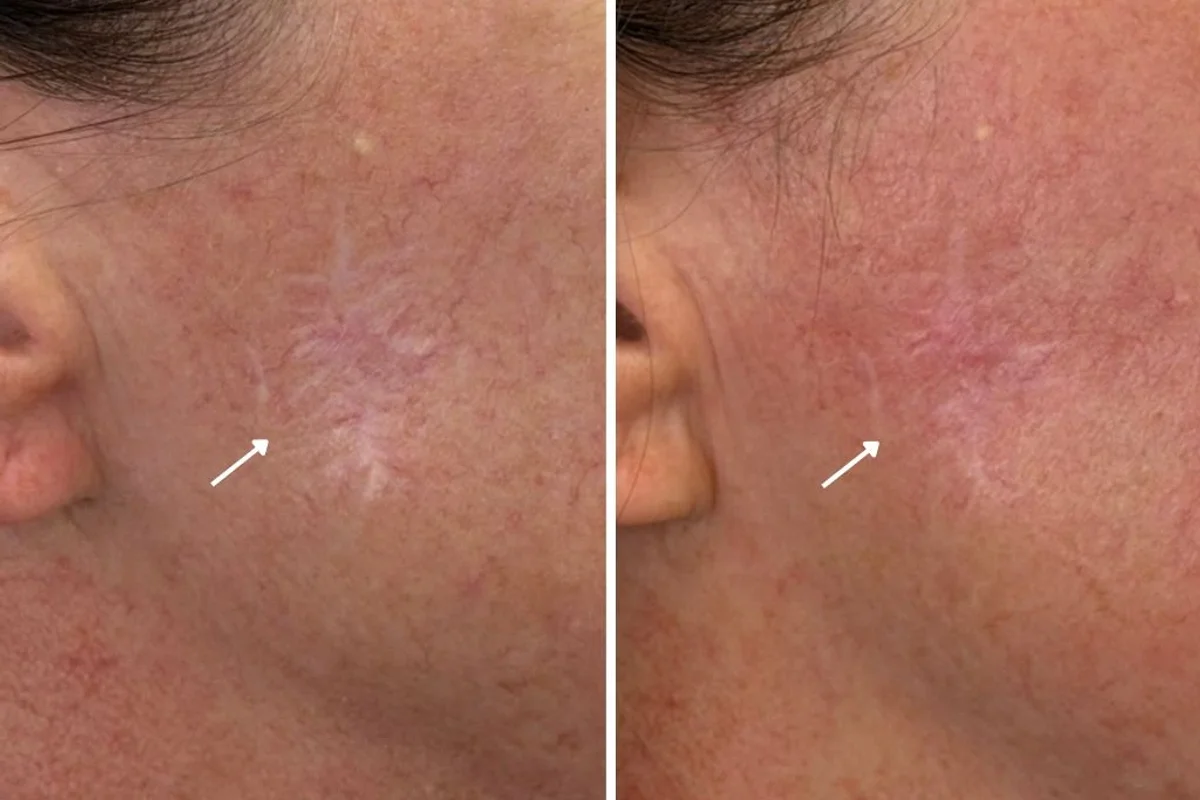 Alpha_Medical_Aesthetics_facial_scar_removal_in_las_vegas_Featured_1200x800_Las_Vegas