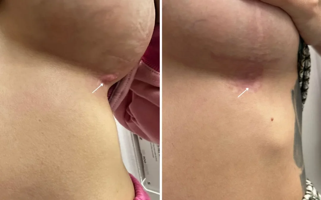 How Much Does ResurFX Laser Cost?