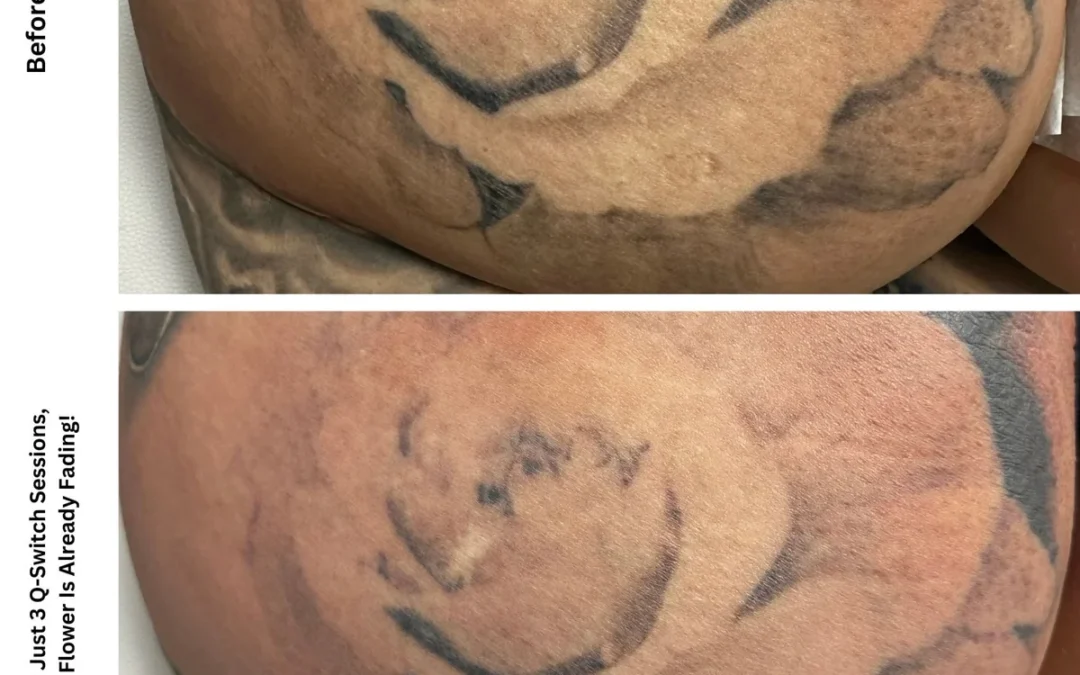 How Much Does Tattoo Removal Cost in Las Vegas?