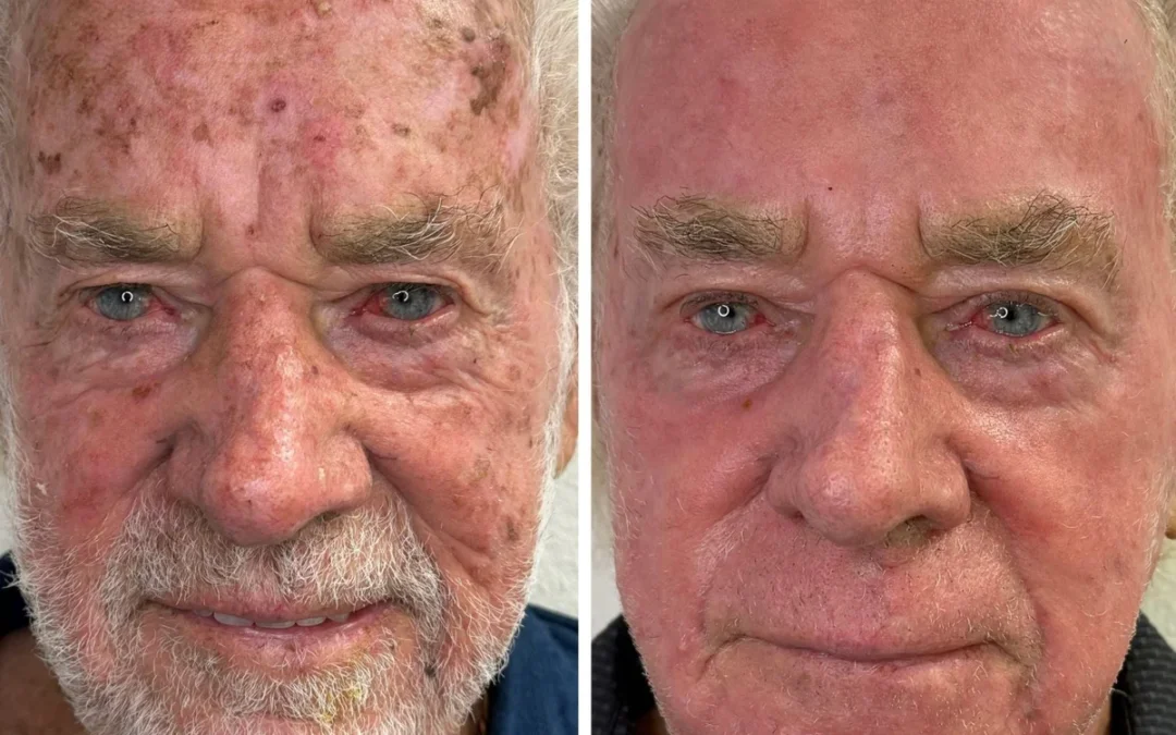 Male Facial Rejuvenation