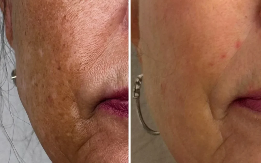 Melasma Treatment in Las Vegas: Why It Keeps Coming Back and How to Actually Fix It