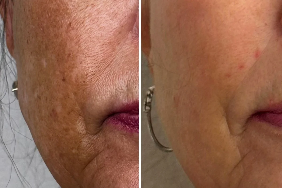 Alpha_Medical_Aesthetics_melasma_treatment_in_las_vegas_Featured_1200x800_Las_Vegas