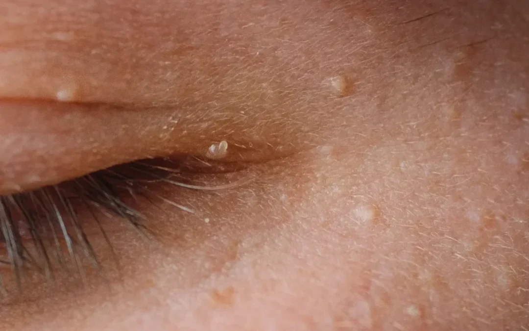 Milia & Ablative CO2 Laser Resurfacing