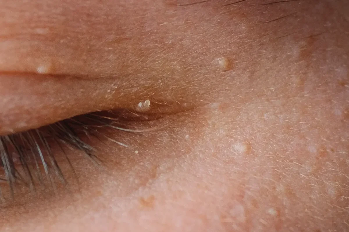 Advanced CO2 laser resurfacing in Las Vegas