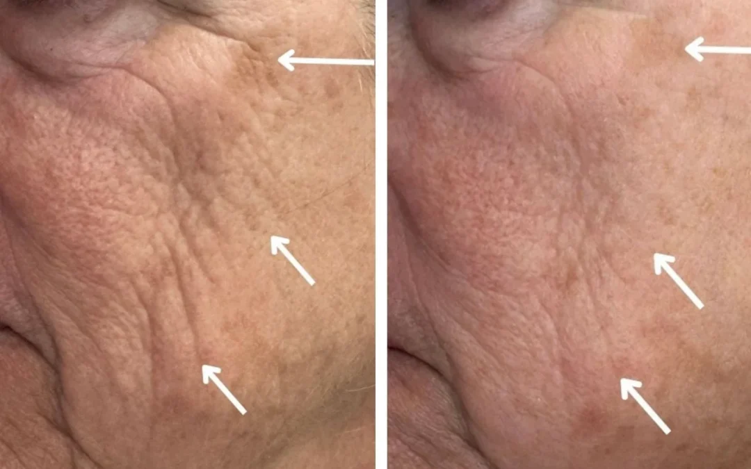 Non-Surgical Facelift Costs & Options explained by Dr. Kaveh