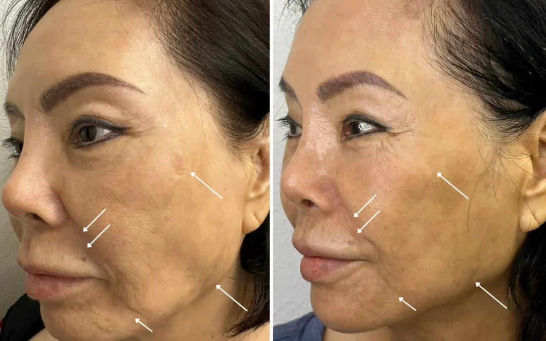 Best Non-Surgical Facelift in Las Vegas: 3-in-1 triLift Lower Face Lifting & Jaw Contouring