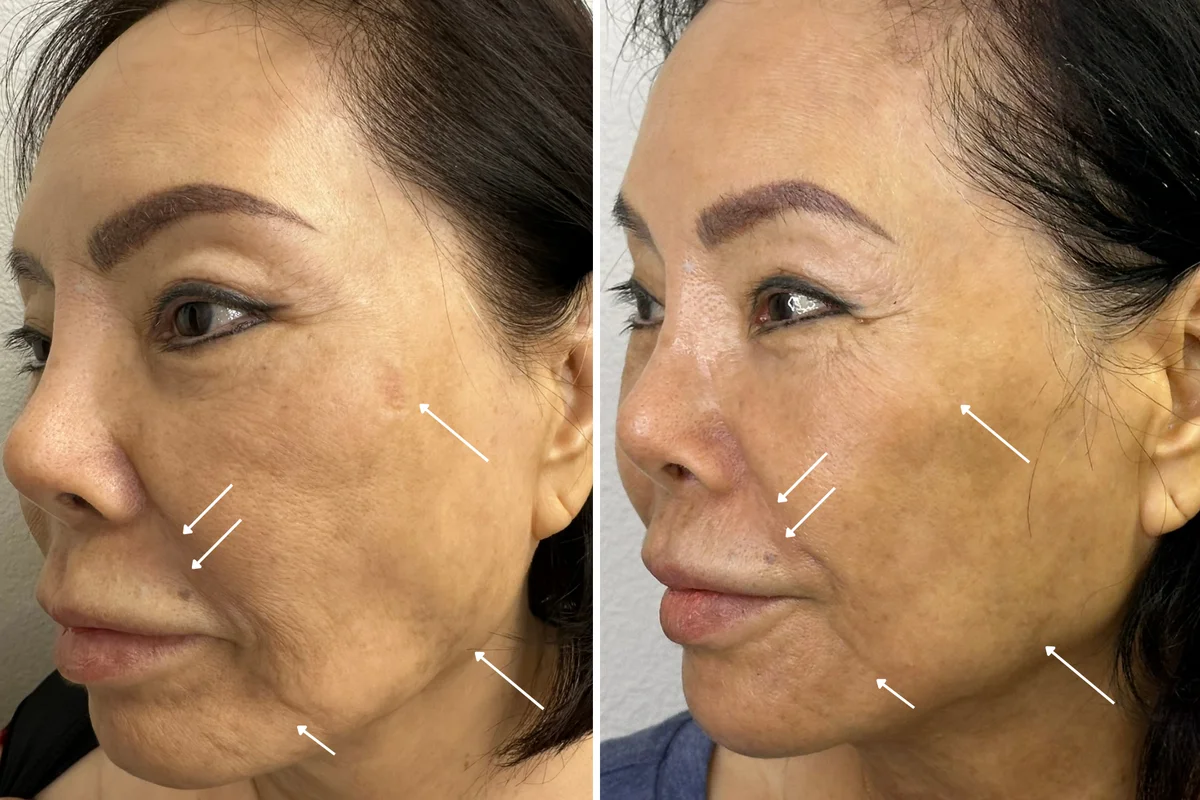 Alpha_Medical_Aesthetics_non_surgical_facelift_in_las_vegas_trilift_before_after_results_recovery_time_an_Featured_1200x800_Las_Vegas
