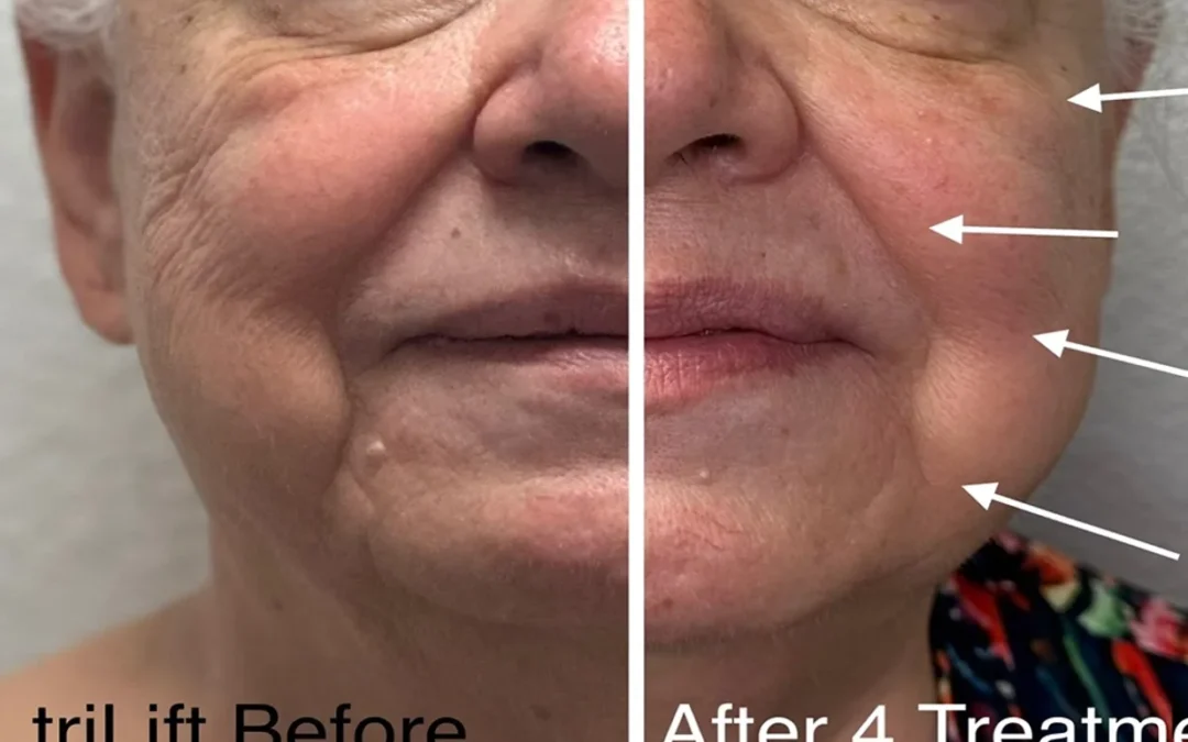 Read to find out how much triLift treatment costs?
