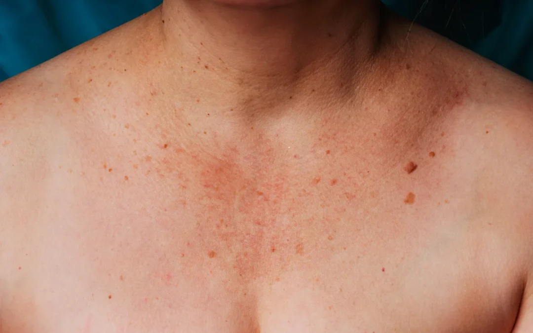 3 Irresistible Reasons Why You Should Choose Our Skin Doctor for IPL Pigmentation Removal