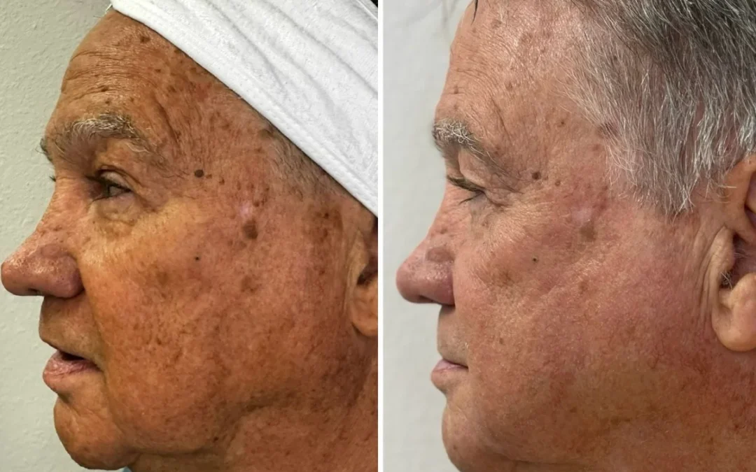 SmoothGLO by Lumenis: The Dual-Powered Treatment Transforming Skin in Las Vegas