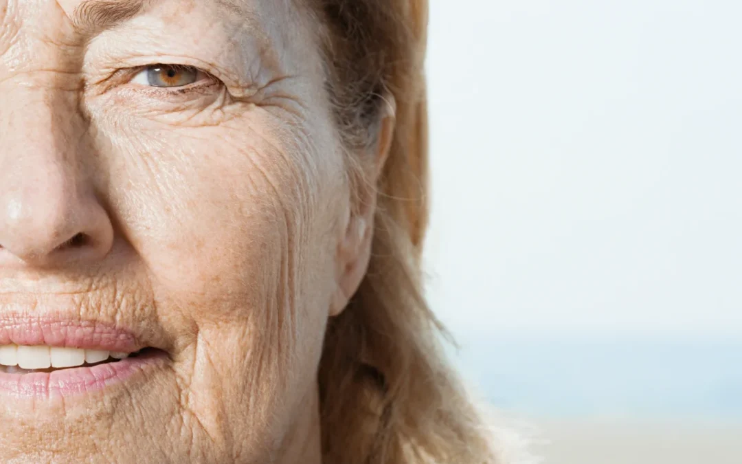 Solar Elastosis & Non-Surgical Resurfacing