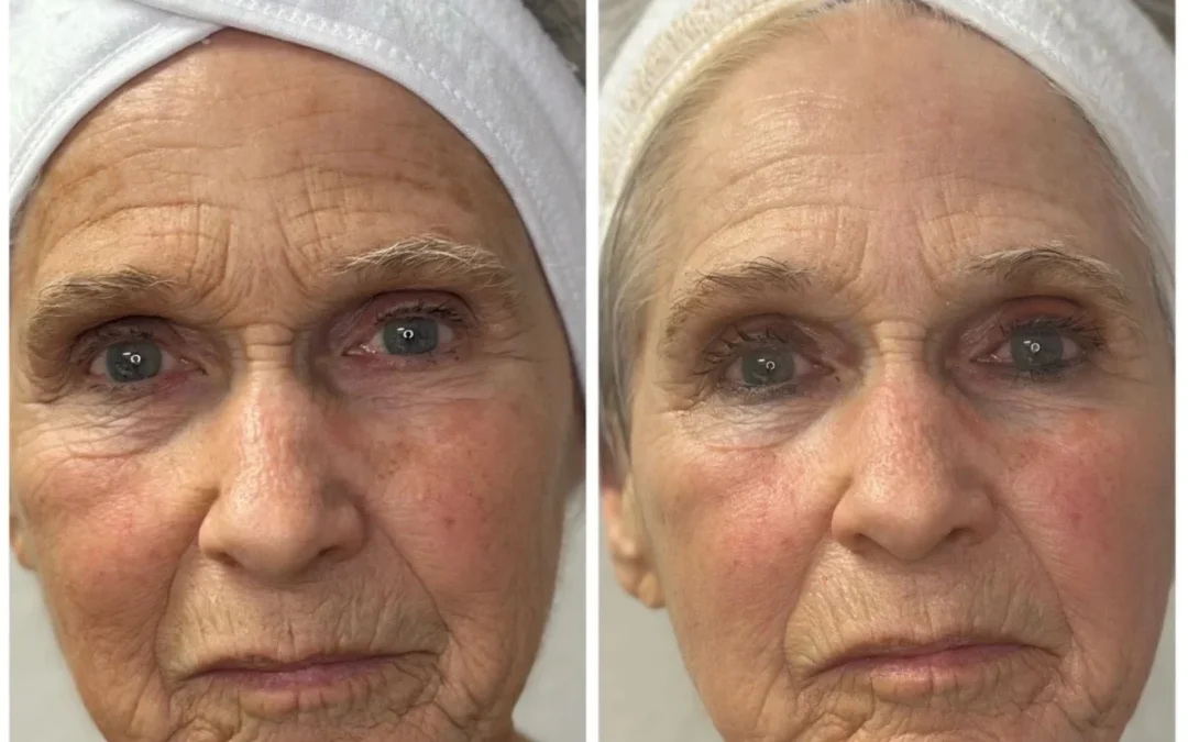 The Surprising Truth About Photofractional Healing!
