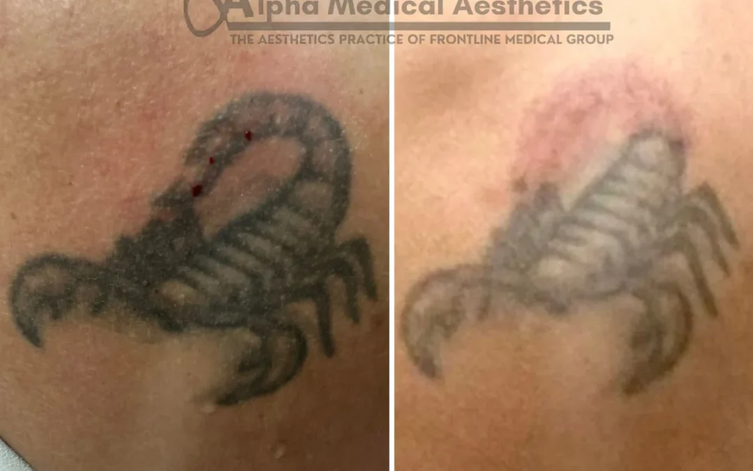 Top 5 Laser Tattoo Removal Questions Answered by a Doctor
