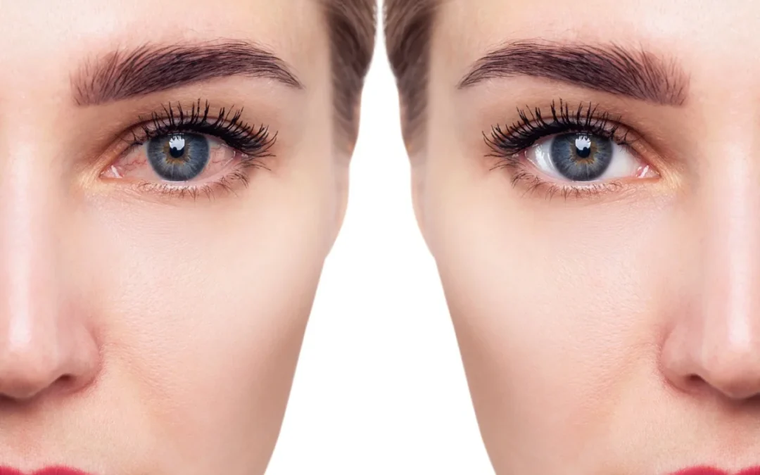 Treatments for Dry Eyes