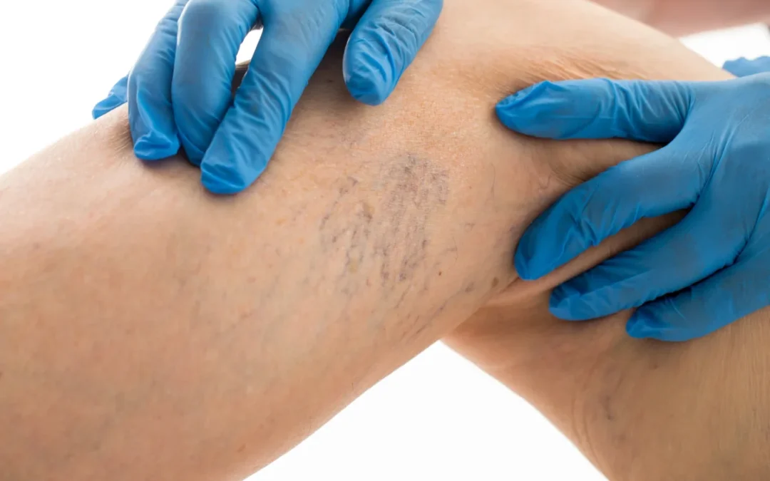 Understanding Varicose Veins Surgery