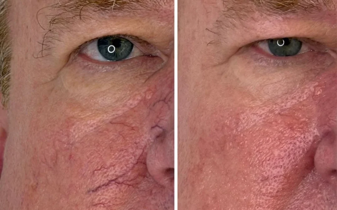 Vascular Lesions Removal on the Face