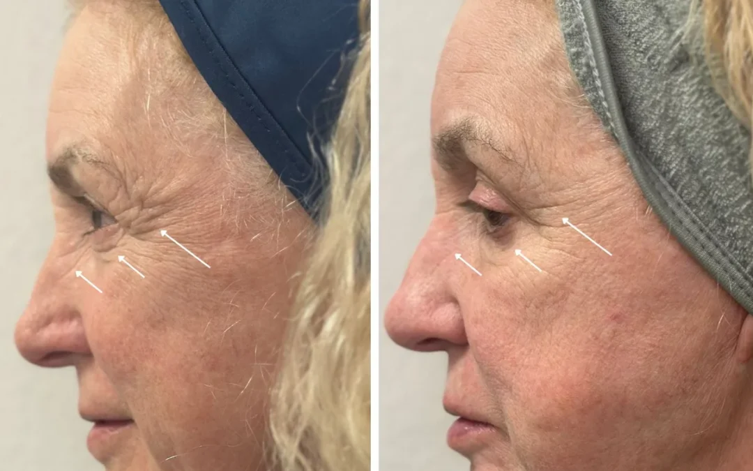 What is ResurFX Laser and How Does It Work?