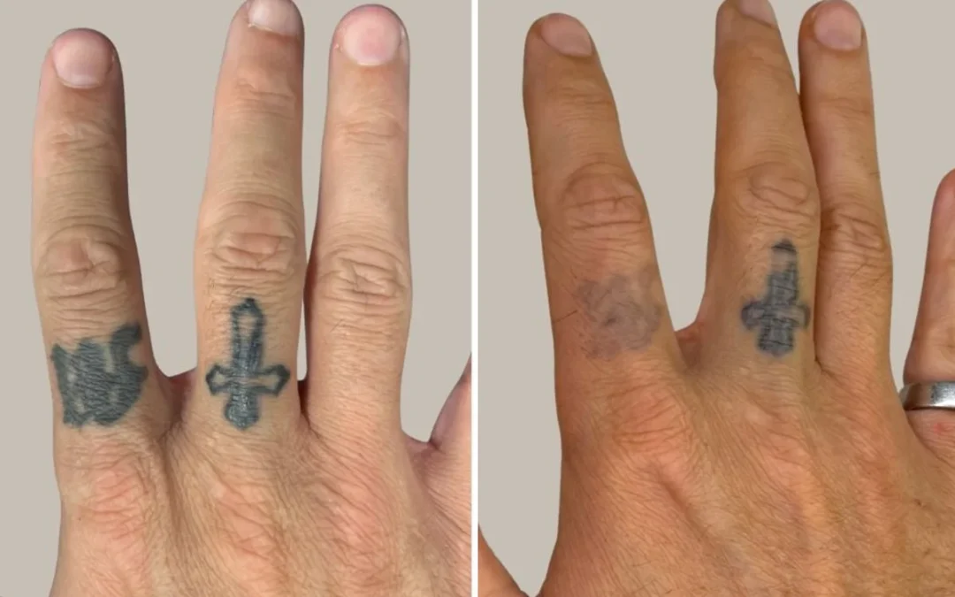 What Most People Get Wrong About Laser Tattoo Removal and Scarring