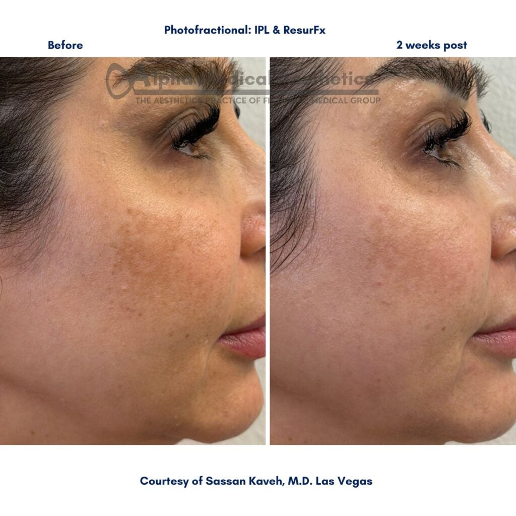 Photofractional IPL & ResurFx — Before & After 2 — Alpha Medical Aesthetics Las Vegas Photofractional IPL & ResurFx before and after — by Dr. Sassan Kaveh at Alpha Medical Aesthetics in Las Vegas