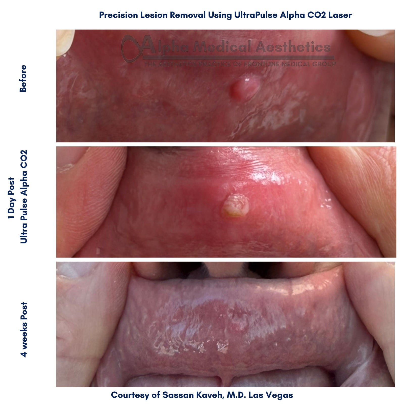 Precision Lesion Removal with SuperFrecator— by Dr. Sassan Kaveh at Alpha Medical Aesthetics in Las Vegas. Medical spa vs Dermatologist