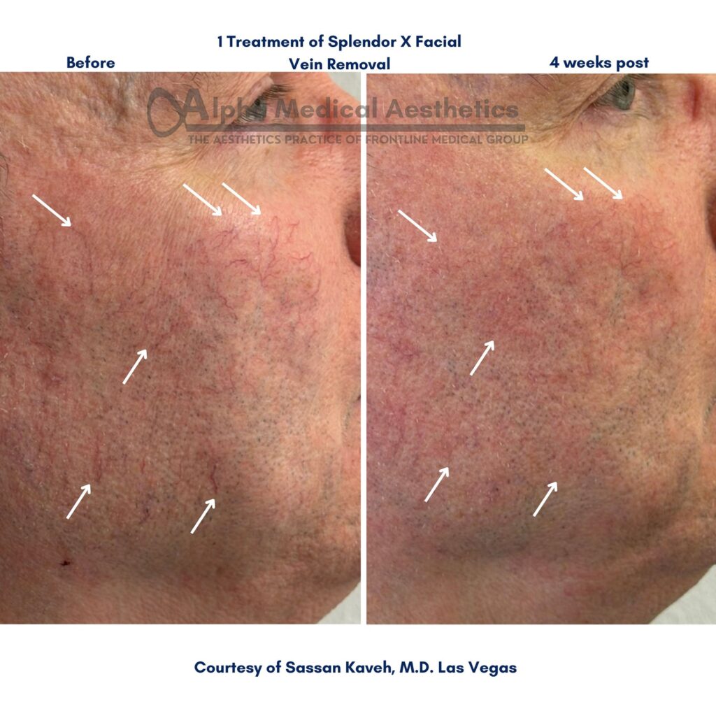 SplendorX Facial Vein Removal — Before & After 2 — Alpha Medical Aesthetics Las Vegas SplendorX Facial Vein Removal before and after 2 — by Dr. Sassan Kaveh at Alpha Medical Aesthetics in Las Vegas