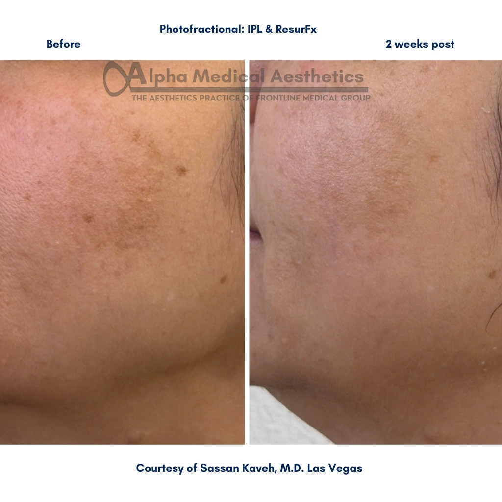 Alpha_Medical_Aesthetics_Lumenis_IPL_And_ResurFX_Treatment_Pigmentation_Removal_Las Vegas Alpha_Medical_Aesthetics_Lumenis_IPL_And_ResurFX_Treatment_Pigmentation_Removal_Las Vegas