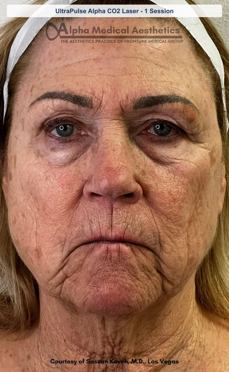 UltraPulse Alpha CO2 laser resurfacing before and after in Las Vegas - one session, softened fine lines and smoother texture (Before)