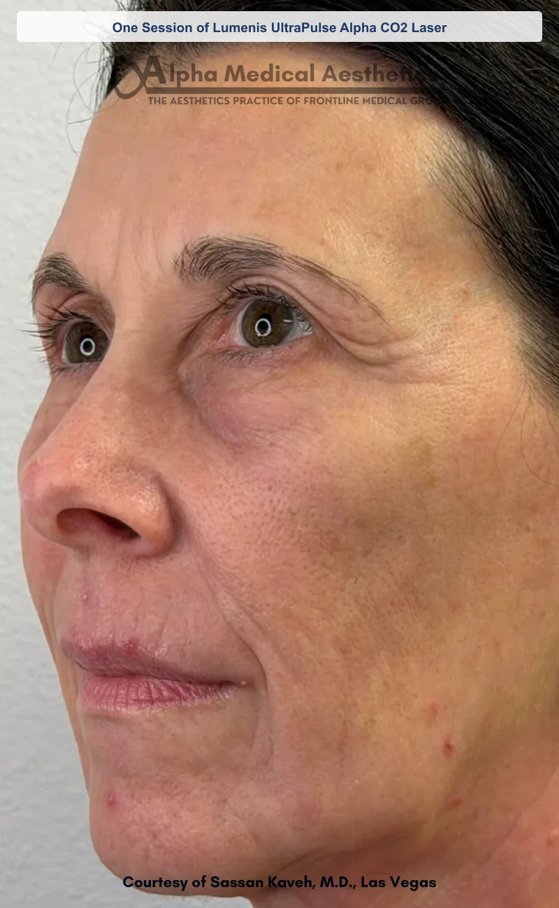 UltraPulse Alpha CO2 laser resurfacing before and after in Las Vegas - one session, smoother skin texture and softened lines (After)