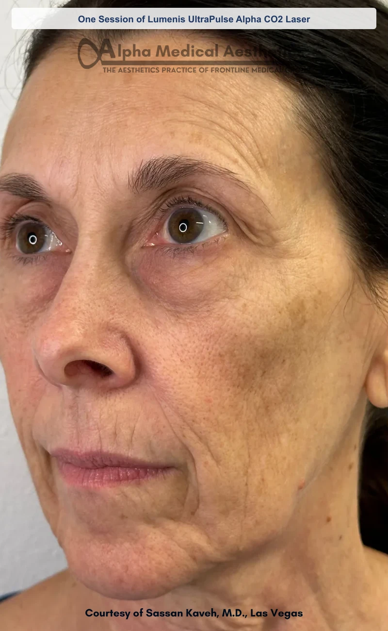 UltraPulse Alpha CO2 laser resurfacing before and after in Las Vegas - one session, smoother skin texture and softened lines (Before)