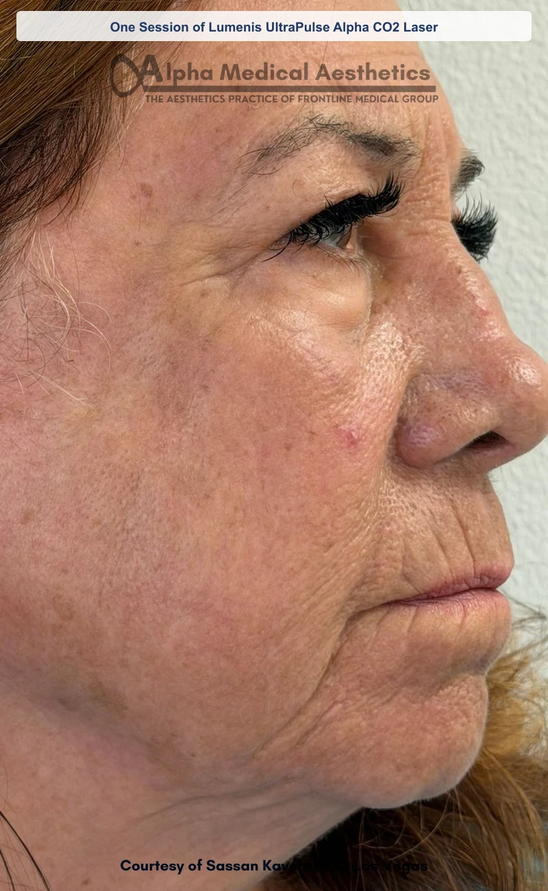 UltraPulse Alpha CO2 laser resurfacing before and after in Las Vegas - one session, softened fine lines, scars and texture (After)