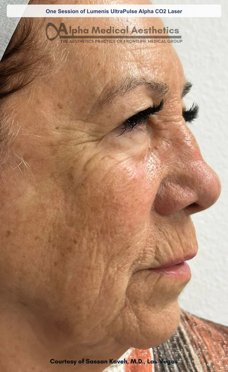 UltraPulse Alpha CO2 laser resurfacing before and after in Las Vegas - one session, softened fine lines, scars and texture (Before)