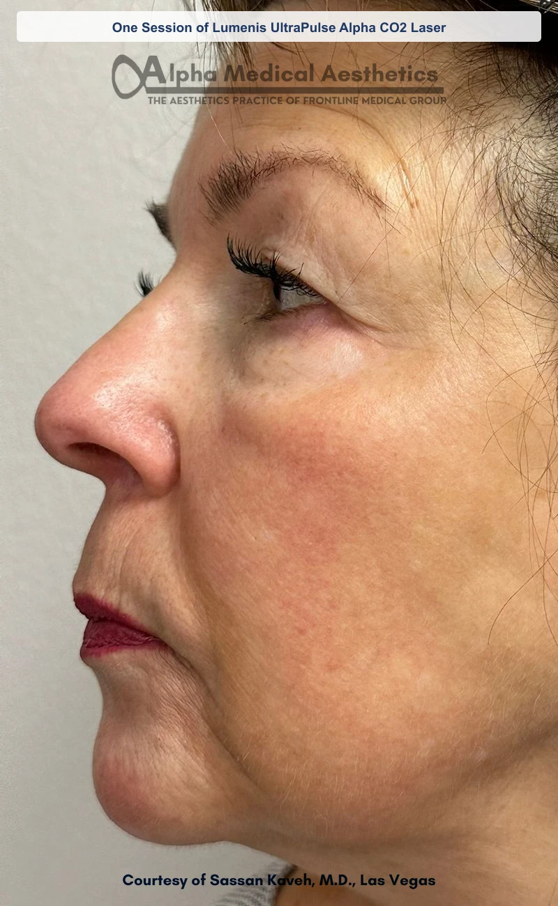 One Session of Lumenis UltraPulse Alpha CO2 Laser before and after in Las Vegas by Dr. Sassan Kaveh (After)
