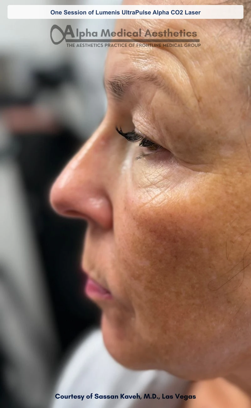 One Session of Lumenis UltraPulse Alpha CO2 Laser before and after in Las Vegas by Dr. Sassan Kaveh (Before)