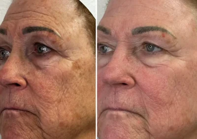 Alpha Medical Aesthetics Ablative Laser Resurfacing Lumenis UltraPulse Alpha CO2 Facial Treatment By Dr. Sassan Kaveh Anthem Las Vegas 007
