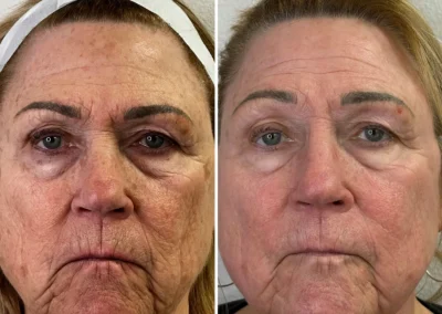 Alpha Medical Aesthetics Ablative Laser Resurfacing Lumenis UltraPulse Alpha CO2 Facial Treatment By Dr. Sassan Kaveh Anthem Las Vegas 008